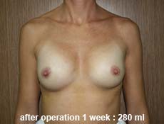 plastic-surgery-breast-augmentation 